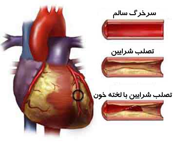 چربی هایی که برای قلب مفیدند (2 نکته مهم)