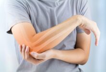 چگونه بفهمیم استخوان شکسته جوش خورده است ؟ (2 نکته مهم)