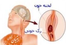 یک راهکار کم هزینه برای پیشگیری از سکته مغزی  (2 نکته مهم)