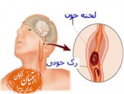 یک راهکار کم هزینه برای پیشگیری از سکته مغزی  (2 نکته مهم)
