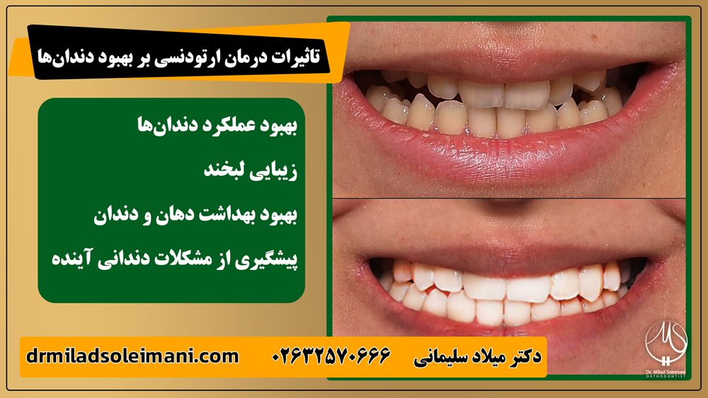 چه کسانی کاندید مناسب ارتودنسی چهار دندان جلویی هستند؟
