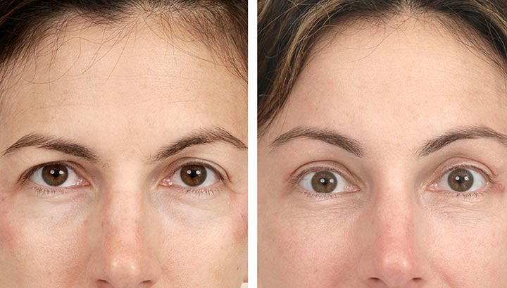 نقش لیفت ابرو (Brow Lift): وقتی مشکل از بالاتر شروع می‌شود
